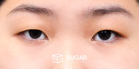슈가성형외과 첫) 자연유착 + 눈매교정 + 앞트임 전후사진 - 수술 전