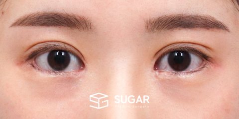 슈가성형외과 재) 재수술 + 절개(두 줄 따기) + 눈 밑 지방재배치 + 뒤밑트임 + 앞트임 복원 흉터 주사 전후사진 - 수술 전