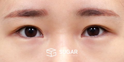 슈가성형외과 재) 재수술 + 뒤밑트임 전후사진 - 수술 전