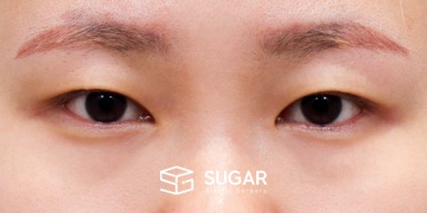 슈가성형외과 첫) 자연유착 전후사진 - 수술 전