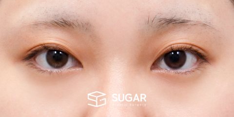 슈가성형외과 첫) 자연유착 + 눈매교정 + 뒤밑트임 전후사진 - 수술 전