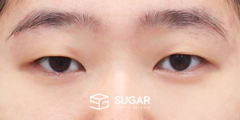 슈가성형외과 첫) 자연유착 + 눈매교정 + 윗트임 전후사진 - 수술 전