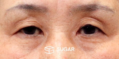슈가성형외과 첫) 눈썹 거상 + 상안검 + 눈 위 지방 제거 전후사진 - 수술 전