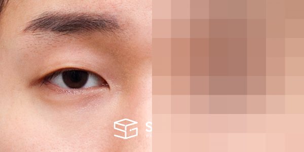 슈가성형외과 첫) 자연유착 + 눈매교정 전후사진 - 정면 수술 전후 비교