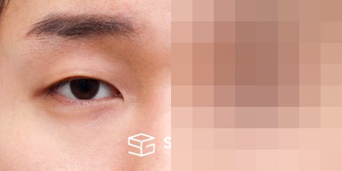 슈가성형외과 첫) 자연유착 + 눈매교정 전후사진 - 정면 수술 전후 비교