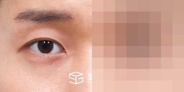 슈가성형외과 첫) 자연유착 + 눈매교정 전후사진 - 45도 수술 전후 비교