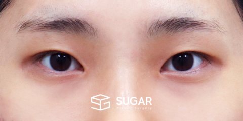 슈가성형외과 첫) 자연유착 + 눈매교정 + 윗트임 + 뒤밑트임 전후사진 - 수술 전