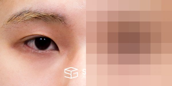 슈가성형외과 첫) 윗트임 + 뒤밑트임 전후사진 - 정면 수술 전후 비교