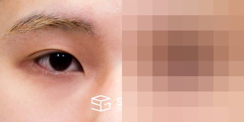 슈가성형외과 첫) 윗트임 + 뒤밑트임 전후사진 - 정면 수술 전후 비교