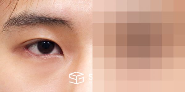 슈가성형외과 첫) 윗트임 + 뒤밑트임 전후사진 - 45도 수술 전후 비교
