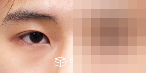 슈가성형외과 첫) 윗트임 + 뒤밑트임 전후사진 - 45도 수술 전후 비교