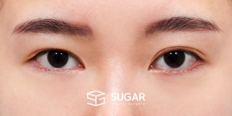 슈가성형외과 재) 재수술 + 뒤밑트임 전후사진 - 수술 전