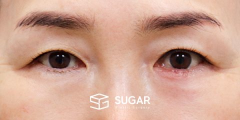슈가성형외과 첫) 눈썹 거상 + 자연유착 + 눈 위 지방 제거 전후사진 - 수술 전