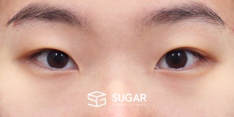 슈가성형외과 첫) 자연유착 + 눈매교정 + 앞트임 + 뒤밑트임 전후사진 - 수술 전