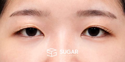 슈가성형외과 첫) 자연유착 + 눈매교정 + 앞트임 + 윗트임 전후사진 - 수술 전