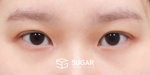 슈가성형외과 첫) 윗트임[R] + 뒤밑트임 전후사진 - 수술 전