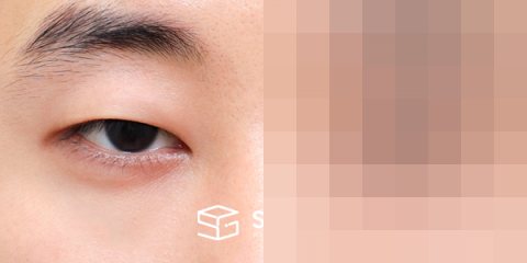 슈가성형외과 첫) 자연유착 + 눈매교정 + 뒤밑트임 전후사진 - 정면 수술 전후 비교