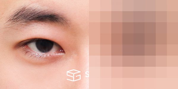 슈가성형외과 첫) 자연유착 + 눈매교정 + 뒤밑트임 전후사진 - 45도 수술 전후 비교
