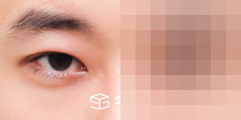 슈가성형외과 첫) 자연유착 + 눈매교정 + 뒤밑트임 전후사진 - 45도 수술 전후 비교