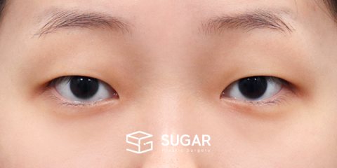 슈가성형외과 첫) 자연유착 + 눈매교정 + 앞트임 전후사진 - 수술 전