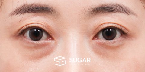슈가성형외과 첫) 자연유착 + 눈매교정 + 눈 밑 지방재배치 전후사진 - 수술 전