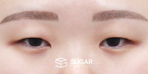 슈가성형외과 첫) 절개 + 앞트임 + 뒤밑트임 전후사진 - 수술 전