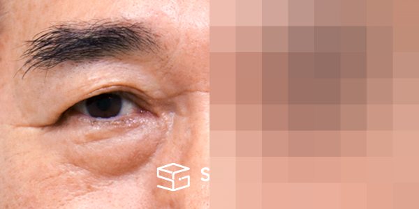 슈가성형외과 첫) 눈썹 거상 + 중안면부 거상 + 하안검 + 자연유착 전후사진 - 정면 수술 전후 비교