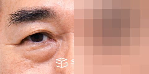 슈가성형외과 첫) 눈썹 거상 + 중안면부 거상 + 하안검 + 자연유착 전후사진 - 정면 수술 전후 비교