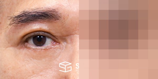 슈가성형외과 첫) 눈썹 거상 + 중안면부 거상 + 하안검 + 자연유착 전후사진 - 45도 수술 전후 비교