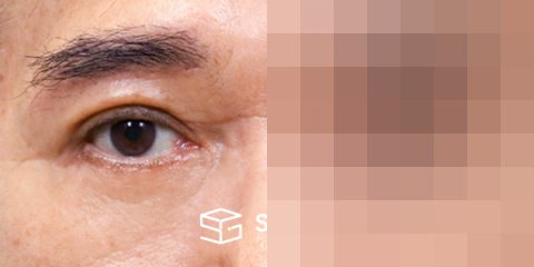 슈가성형외과 첫) 눈썹 거상 + 중안면부 거상 + 하안검 + 자연유착 전후사진 - 45도 수술 전후 비교
