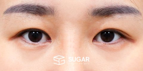 슈가성형외과 첫) 자연유착 + 윗트임 전후사진 - 수술 전