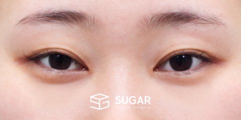 슈가성형외과 첫) 밑트임 전후사진 - 수술 전
