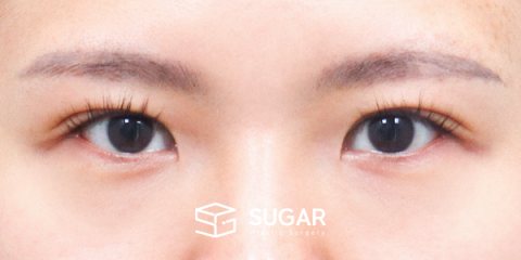 슈가성형외과 첫) 앞트임 + 뒤밑트임 전후사진 - 수술 전