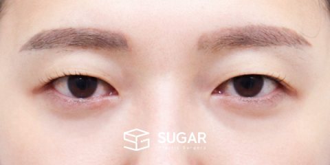슈가성형외과 첫) 자연유착 + 눈매교정 전후사진 - 수술 전
