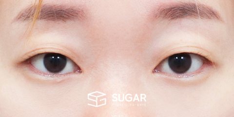 슈가성형외과 첫) 자연유착 전후사진 - 수술 전