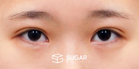 슈가성형외과 재) 재수술 + 절개(두 줄 따기) 전후사진 - 수술 전