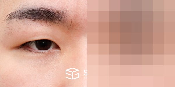 슈가성형외과 첫) 자연유착 + 눈매교정 전후사진 - 정면 수술 전후 비교