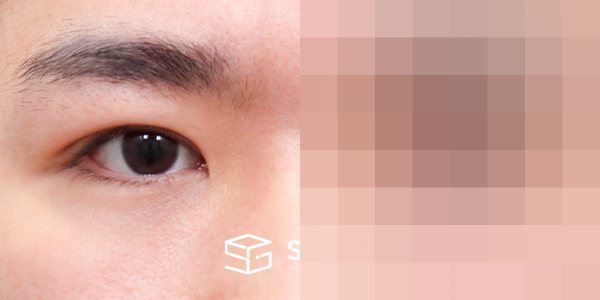 슈가성형외과 첫) 자연유착 + 눈매교정 전후사진 - 45도 수술 전후 비교