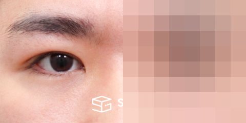 슈가성형외과 첫) 자연유착 + 눈매교정 전후사진 - 45도 수술 전후 비교