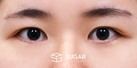 슈가성형외과 재) 재수술 + 절개 전후사진 - 수술 전