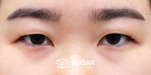 슈가성형외과 첫) 절개 + 앞트임 + 뒤밑트임 전후사진 - 수술 전