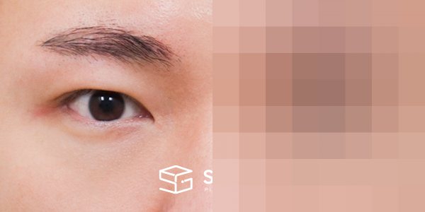 슈가성형외과 첫) 자연유착 + 눈매교정 + 밑트임 전후사진 - 정면 수술 전후 비교