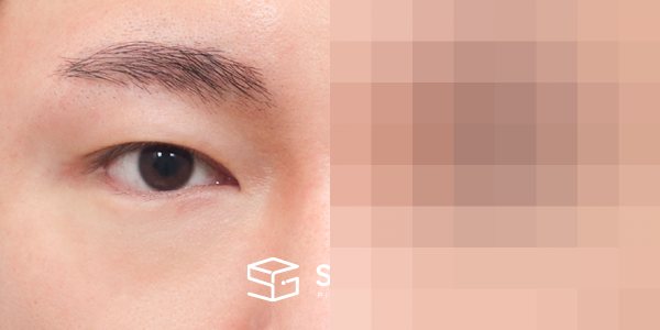 슈가성형외과 첫) 자연유착 + 눈매교정 + 밑트임 전후사진 - 45도 수술 전후 비교
