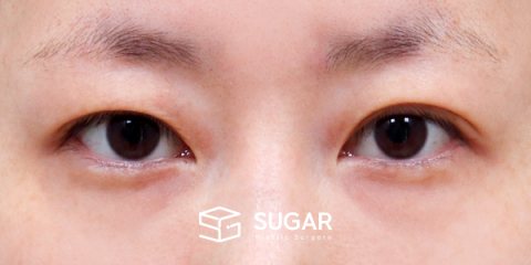 슈가성형외과 재) 재수술 + 자연유착 전후사진 - 수술 전