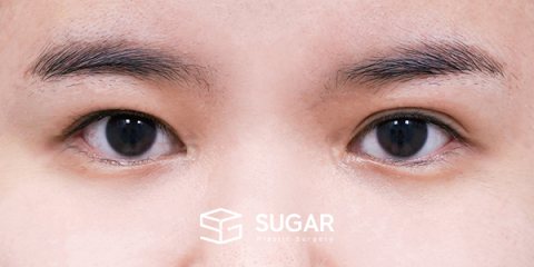 슈가성형외과 첫) 절개[R] + 뒤밑트임 전후사진 - 수술 전
