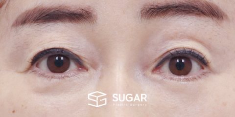 슈가성형외과 첫) 눈썹 거상 + 자연유착 전후사진 - 수술 전