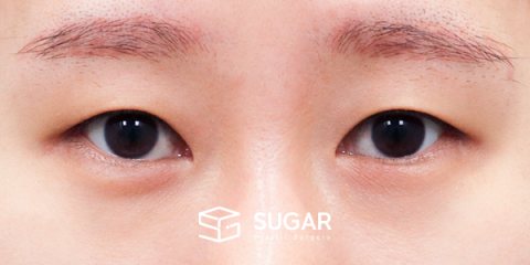 슈가성형외과 첫) 자연유착 + 눈매교정 + 윗트임 + 뒤밑트임 전후사진 - 수술 전