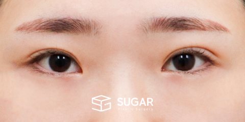 슈가성형외과 첫) 2Point 웨이브 밑트임 전후사진 - 수술 전