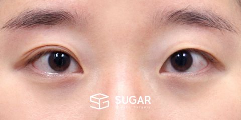 슈가성형외과 첫) 자연유착 + 윗트임 전후사진 - 수술 전