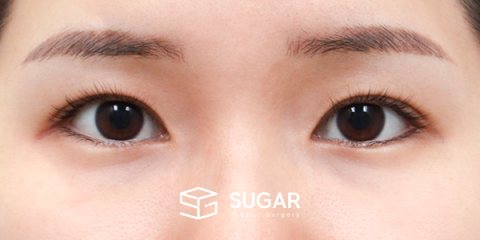 슈가성형외과 첫) 자연유착 + 뒤밑트임 전후사진 - 수술 전